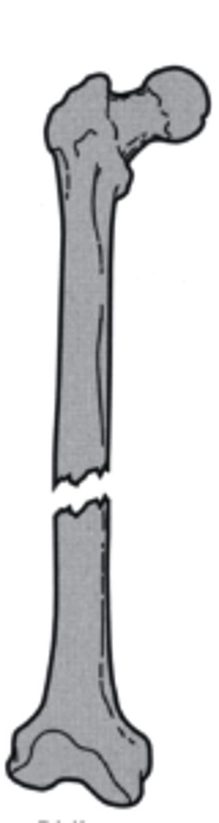 <p>what is the direction of this fracture line?</p><p>a. transverse</p><p>b. longitudinal</p><p>c. oblique</p><p>d. spiral</p>