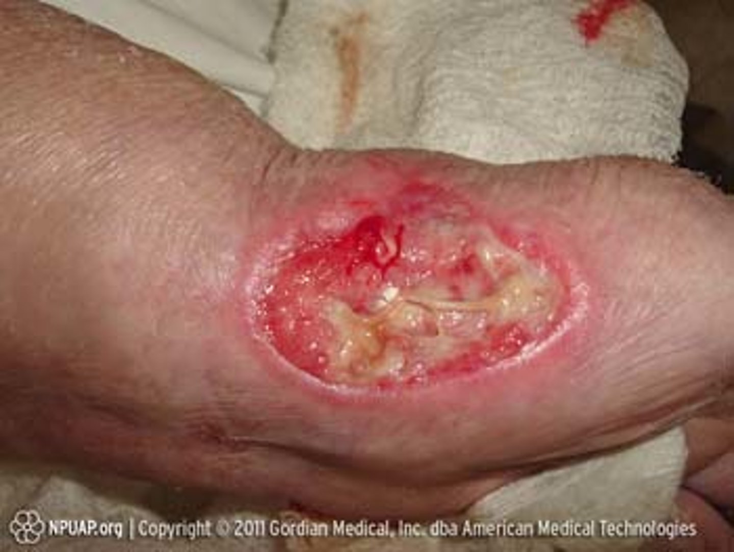 <p>Full-thickness skin loss, in which fat is visible in the ulcer and granulation tissue and rolled wound edges are often present</p>