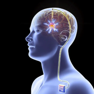 <p>implanting small electrodes in the brain as an attempt to treat mental illness</p>