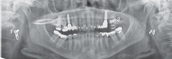 <p><span>·</span><span style="font-family: "Times New Roman"; line-height: normal; font-size: 7pt;"><span> </span></span><span>An artifact seen on a panoramic image that is produced when a metallic or dense object is penetrated twice by the x-ray beam</span></p><p><span>· Could obscure diagnostic information</span></p><ul><li><p>often appear higher than the counterpart</p></li></ul><p></p>