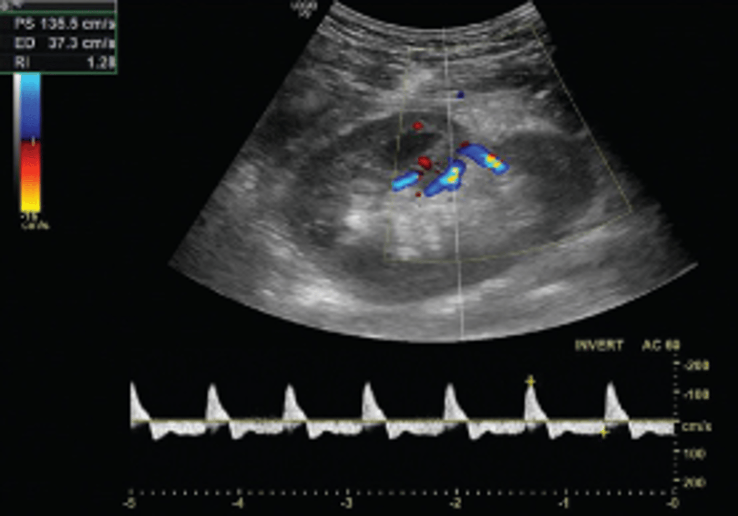 <p>Renal vein thrombosis</p>