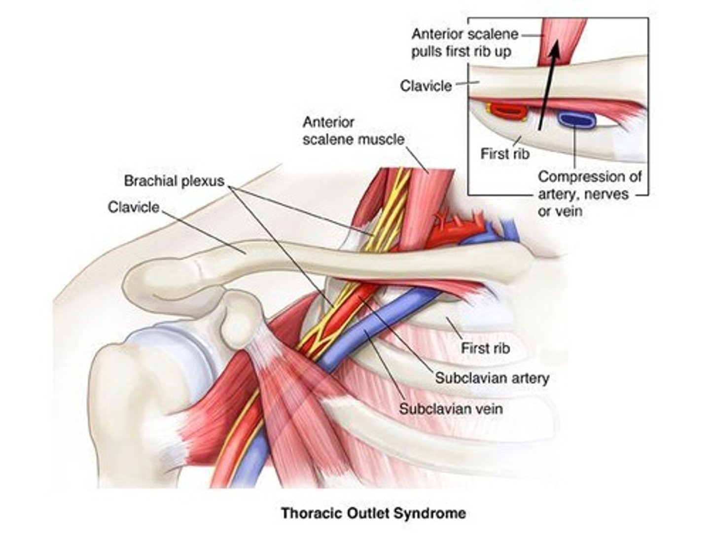<p>A condition caused by compression of nerves or blood vessels in the thoracic outlet.</p>