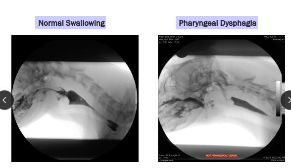 <ul><li><p><span style="background-color: transparent;"><strong><span>Congenital idiopathic megaesophagus:</span></strong><span> GSD, Shar Pei</span></span></p></li><li><p><span style="background-color: transparent;"><strong><span>Myasthenia gravis:</span></strong><span> GSD, Golden</span></span></p><ul><li><p><strong><u>Focal MG:</u></strong> Facial, pharyngeal, laryngeal, esophageal muscle involvement only (≥1)</p></li></ul></li></ul><ul><li><p><span style="background-color: transparent;"><strong><span>Cricopharyngeal achalasia:</span></strong><span> Golden</span></span></p></li><li><p><span style="background-color: transparent;"><strong><span>Hiatal hernia or reflux esophagitis:</span></strong><span> Shar Pei, Bulldog</span></span></p></li></ul><p></p>