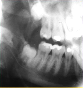 <ul><li><p>image receptor is placed outside the mouth and against the side of the face </p></li><li><p>resultant radiographs are larger and show anatomical structures in both jaws </p></li><li><p>direction of Xray beam on this skull </p></li></ul><p>for right hand side - <strong>tube head left </strong>and receptor opposite - passes between the cervical spine and the left ascending ramus of the mandible - viewed like you are looking at the patient’s right cheek </p>