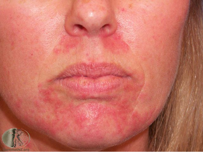 <p>Perioral Dermatitis </p>