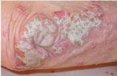 <p><span>An elevated, solid lesion &gt;1 cm in size</span></p>