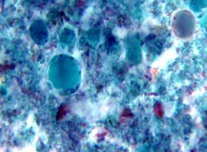 Central vacuolar form blastocystis hominis