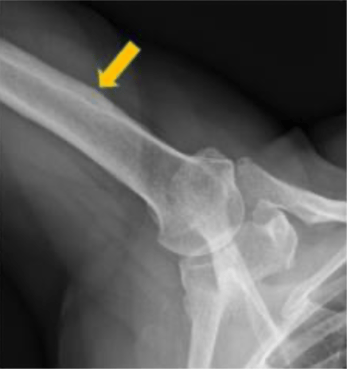 <p>The shaft or diaphysis of the humerus is cylindrical in its upper portion and more triangular distally, with a lateral cortical irregularity called the deltoid tuberosity for the deltoid muscle insertion.</p>
