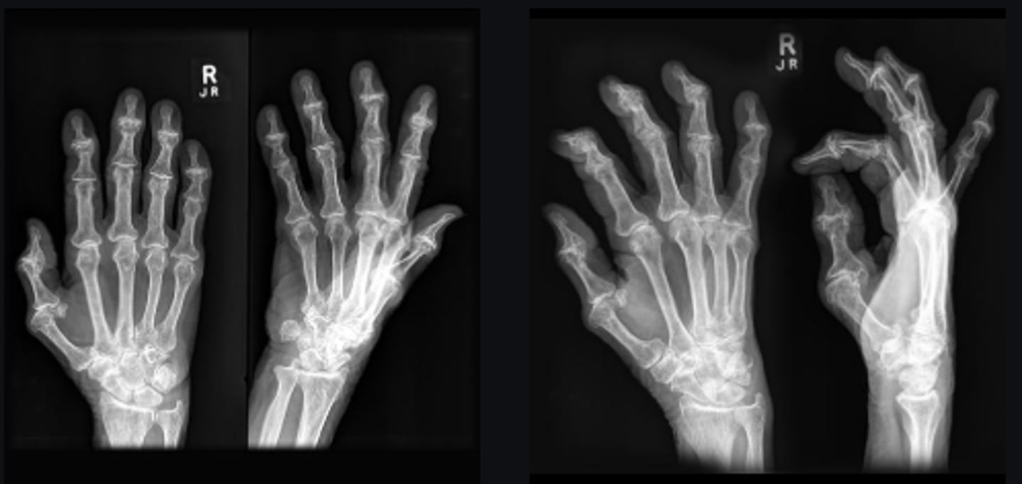 <p>Periarticular osteopenia</p>