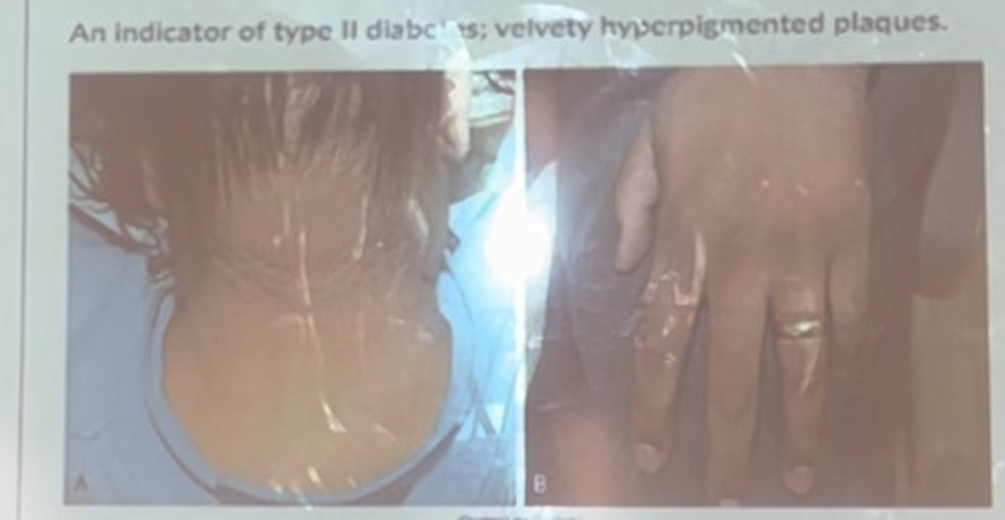 <p>An indicator of type II diabetes; variety hyperpigmented plaques</p>
