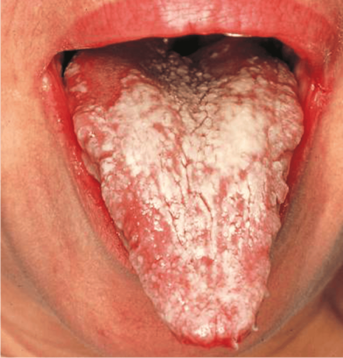 <p>thick plaques</p><p>• seen in HIV/immunocompromised</p><p>• common locations: buccal mucosa/tongue</p>