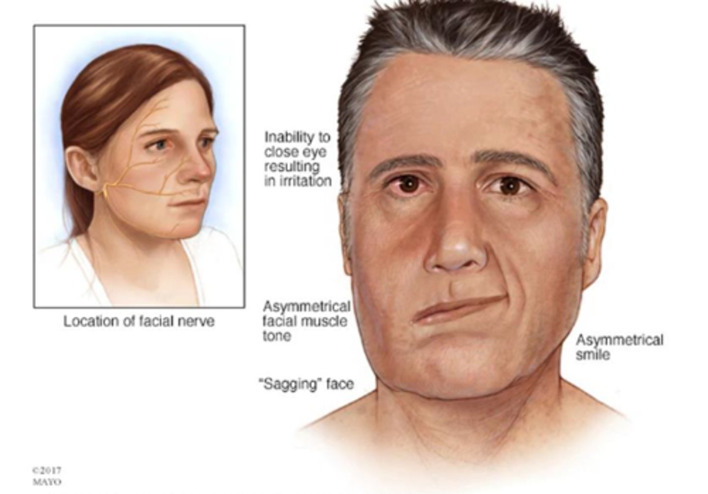 <p>- Unilateral facial weakness of LMN type</p><p>- Loss of taste on ipsilateral tongue</p>