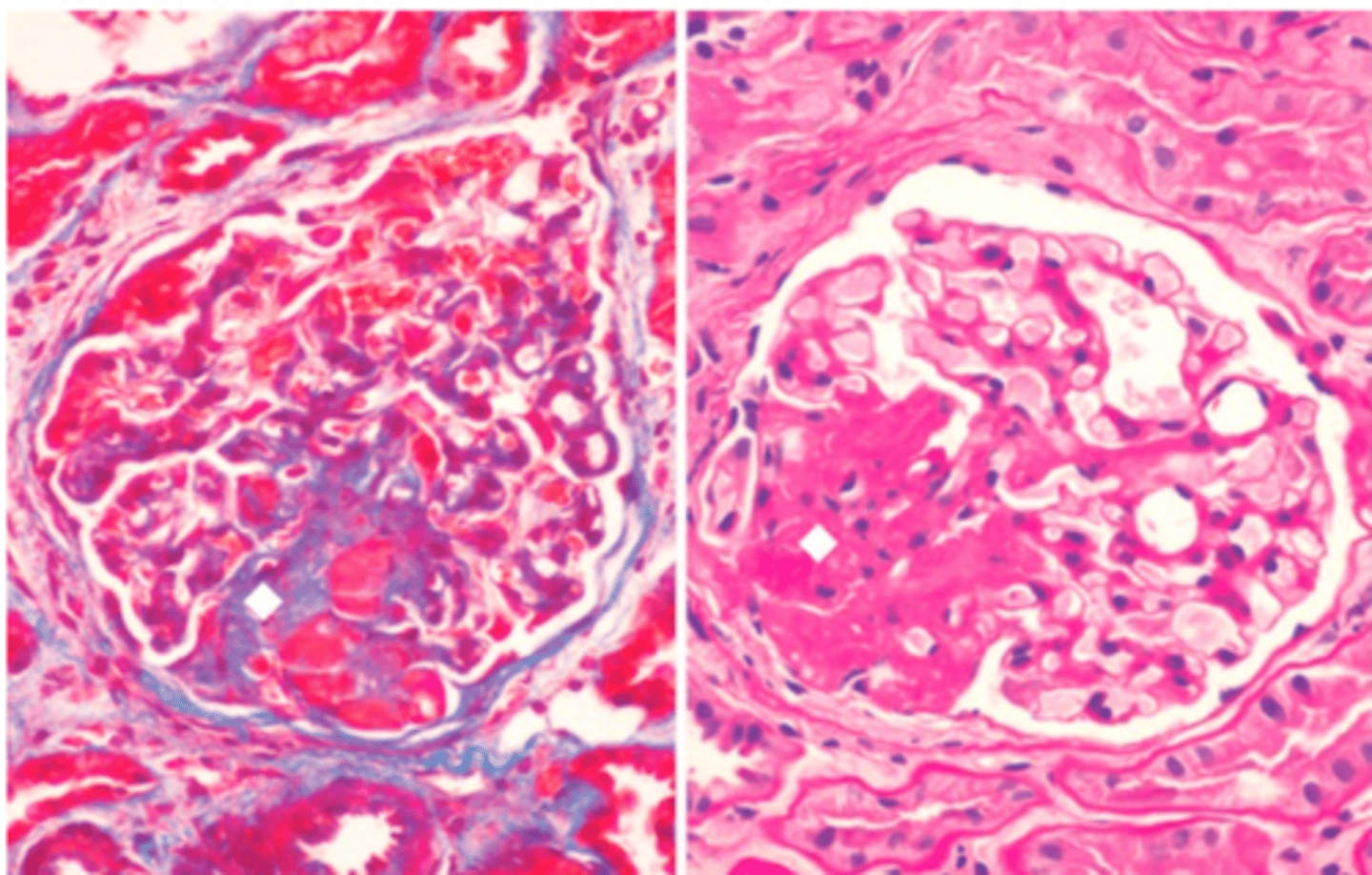 <p>-increased mesangial matrix protein obliterates capillaries + deposition of matrix material (hyaline) throughout the abnormal segment </p><p>-immunofluorescence: nonspecific trapping of antibodies but no immune complexes</p><p>-EM: diffuse foot processes effacement</p>