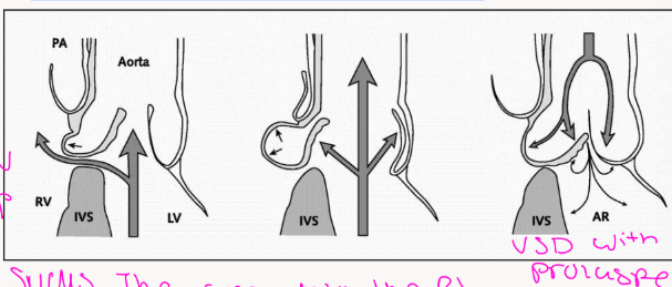 <p>In early systole (left), blood ejected from the</p><p>left ventricle will be shunted through the</p><p>ventricular septal defect</p><p>The unsupported right coronary cusp and</p><p>right aortic sinus are driven into the right</p><p>ventricle. This limits left to right shunting of</p><p>VSD flow</p><p>This is known as the Venturi effect</p>