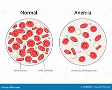 <p>Anemia: Deficiency in hemoglobin or red blood cells. (Decreased oxygen delivery to tissues, low energy levels.)</p><ul><li><p>Possible causes: Hemorrhage (Physical injury), dietary deficiency of iron.</p></li></ul><p></p>