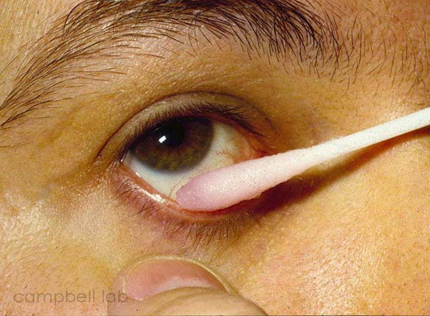 conjunctival swab