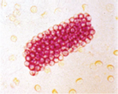 <p>-Collection of RBCs which have leaked into renal tubules through damage of glomerular basement membrane</p><p>-Occurs in Glomerularnephritis</p>