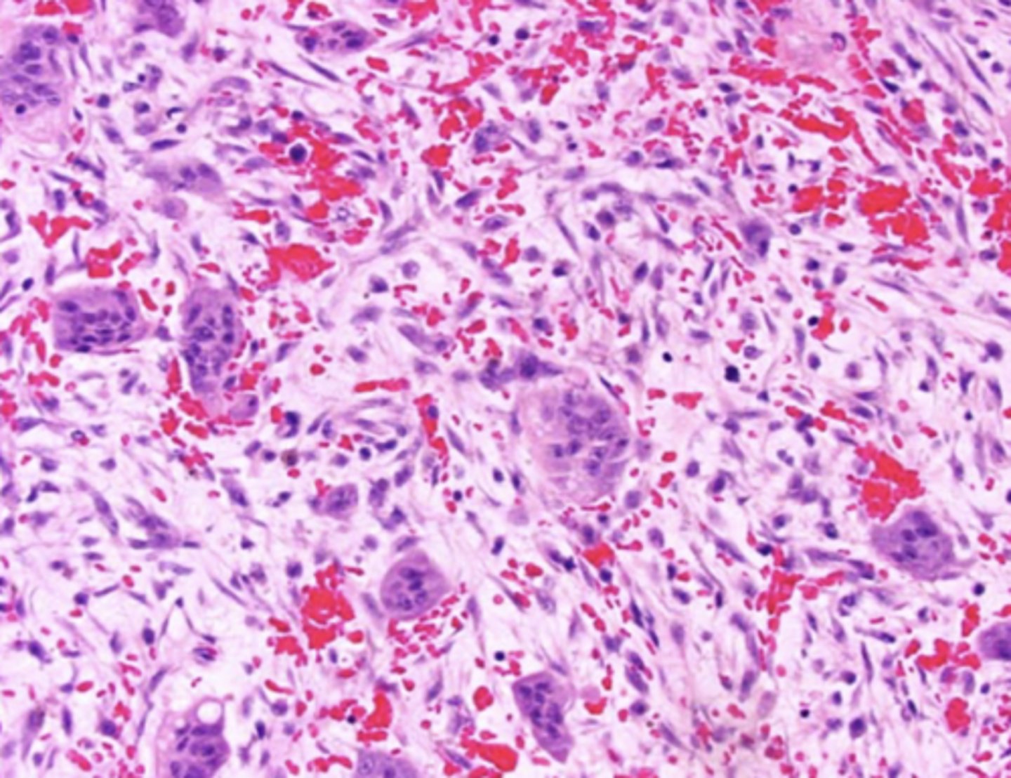 <p>- Multinucleated giant cells</p><p>- Marcophages</p><p>- Areas of hemorrhage</p>