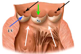 <p>-opening and closing of semilunar valves is a passive process; similar to valves within veins</p><p>-blood forced out of the ventricles results in opening of valves</p><p>-valves close due to elastic recoil of the pulmonary trunk or aorta that propels blood away from the heart as well as back to the heart</p><p>-thickening at the edge of each cusp called a lunule (blue arrow) adds stability to the valve</p><p>-aortic valve differs from the pulmonary valve because the coronary arteries take origin from a depression (sinus) in the wall of the aorta at the level of the cusps (black arrows)</p>