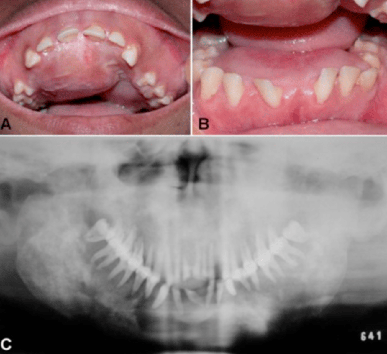 <p>-striking enlargement of the jaws</p><p>-ground glass appearance radiographically</p>