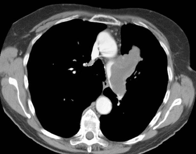 <p>What would be seen on a CT for angiosarcomas?</p>