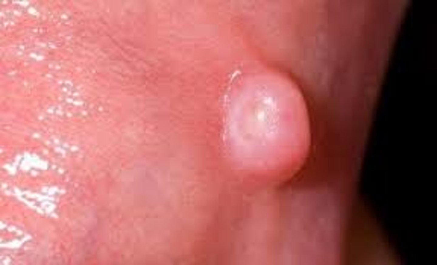 <p>what is this lesion called </p>