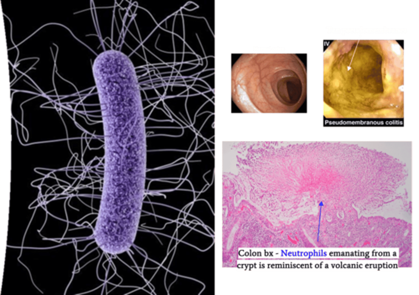 <p>Identify Pathogen causing Diarrhea:</p><p>Anaerobic, Gram-positive, spore forming bacillus</p><p>&gt; MCC of Hospital Accquired Diarrhea</p><p>-Hx:</p><p>&gt; Ubiquitous (found in water, air and soil)</p><p>&gt; Abx Therapy</p><p>&gt;&gt; Clindamycin</p><p>&gt;&gt; Ampicillin</p><p>&gt;&gt; Cephalosporins</p><p>&gt;&gt; Fluoroquinolones</p><p>&gt; PPIs</p><p>&gt; Advanced Age</p><p>-Path: TOXIGENIC (Toxins A &amp; B)</p><p>&gt; Part of normal gut flora --&gt; Abx ==&gt; DISRUPTS normal colonic flora --&gt; colonization and overgrowth</p><p>&gt; Toxin A = enterotoxin damaging brush border of gut (disrupts tight junctions btwn enterocytes) ==&gt; Malabsorption &amp; Diarrhea</p><p>&gt; Toxin B = cytotoxin that induces actin depolymerization -&gt; damage of the cytoskeletal structure and cell death -&gt; significant inflammation within the bowel wall</p><p>-Sx/PE:</p><p>&gt; Asx</p><p>&gt; Gastroenteritis:</p><p>&gt;&gt; Watery Diarrhea</p><p>&gt;&gt; Abd cramping</p><p>&gt;&gt; Fever</p><p>&gt; Severe Infex: Pseudomembranous colitits</p><p>&gt; Fulminant Infex: Toxic Megacolon</p><p>-Dx:</p><p>&gt; (+) Enzyme Immunoassay (EIA) for Toxins A &amp; B</p><p>&gt; Gross: Pseudomembranous colitis</p><p>&gt;&gt; Tan yellow pseudomembranes made up of an adherent layer of inflammatory cells and debris at sites of mucosa injury</p><p>&gt; Histology: Pseudomembranous colitis</p><p>&gt;&gt; Neutrophils "erupting" from crypt like "volcanic eruption"</p><p>-Tx:</p><p>&gt; Supportive Care</p><p>&gt; Abx (Vancomycin &amp; Fidaxomicin)</p><p>&gt; Recurrent = Fecal Microbiota transplant (stool microbiome from a donor is transferred to the patient via capsules, colonoscopy or enema)</p>
