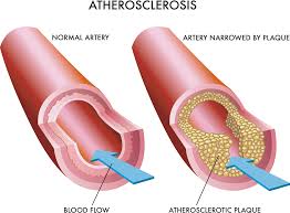 <p>Arteriosclerosis</p>
