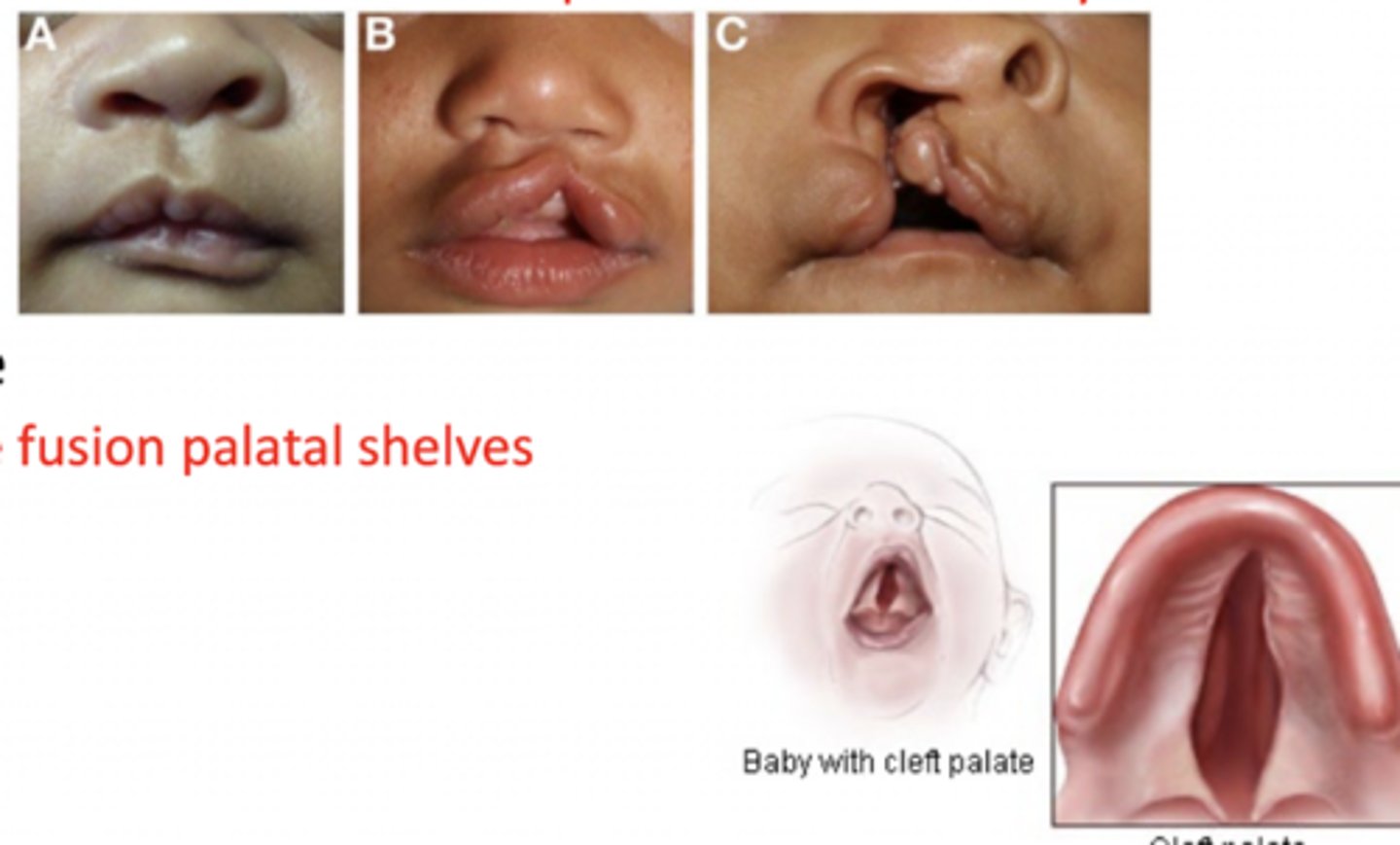 <p>Cleft palate = defective fusion of palatal shelves</p><p>Cleft lip = defective fusion of the medial nasal process with the maxillary process</p>