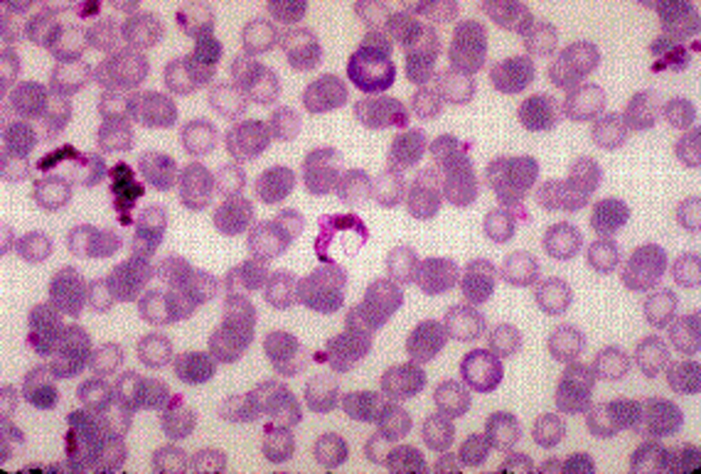 <p>d.Trypanosoma cruzi.</p><p>The primary diagnostic stage in the blood is the trypomastigote. It is an elongated structure 15 to 20 μm long that often appears in a C or U shape. Individuals in the acute phase may be asymptomatic or have local symptoms including the presence of a chagoma (ulcerative skin lesion at the site of the insect bite) or a unilateral edema around the eye (Romaña sign) if the bite is on the ocular conjunctiva. Systemic manifestations include fever, lymphadenitis, hepatosplenomegaly, malaise, muscular pains, and diarrhea and vomiting. The latent phase can last 10 to 40 years after infection, but only about 30% to 40% of patients develop the chronic form of Chagas disease. </p>