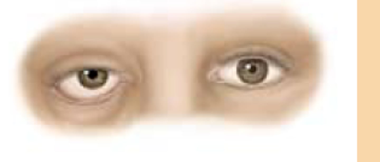<p>drooping eyelid</p><p>can be aging/congenital: absence if eye crease</p><p>new onset : needs urgent FU</p>