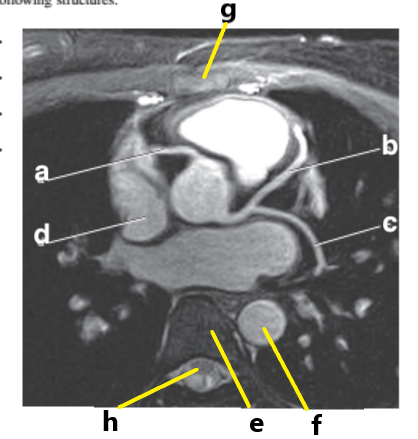 <p><span><span>Which letter is the Descending aorta ?</span></span></p>