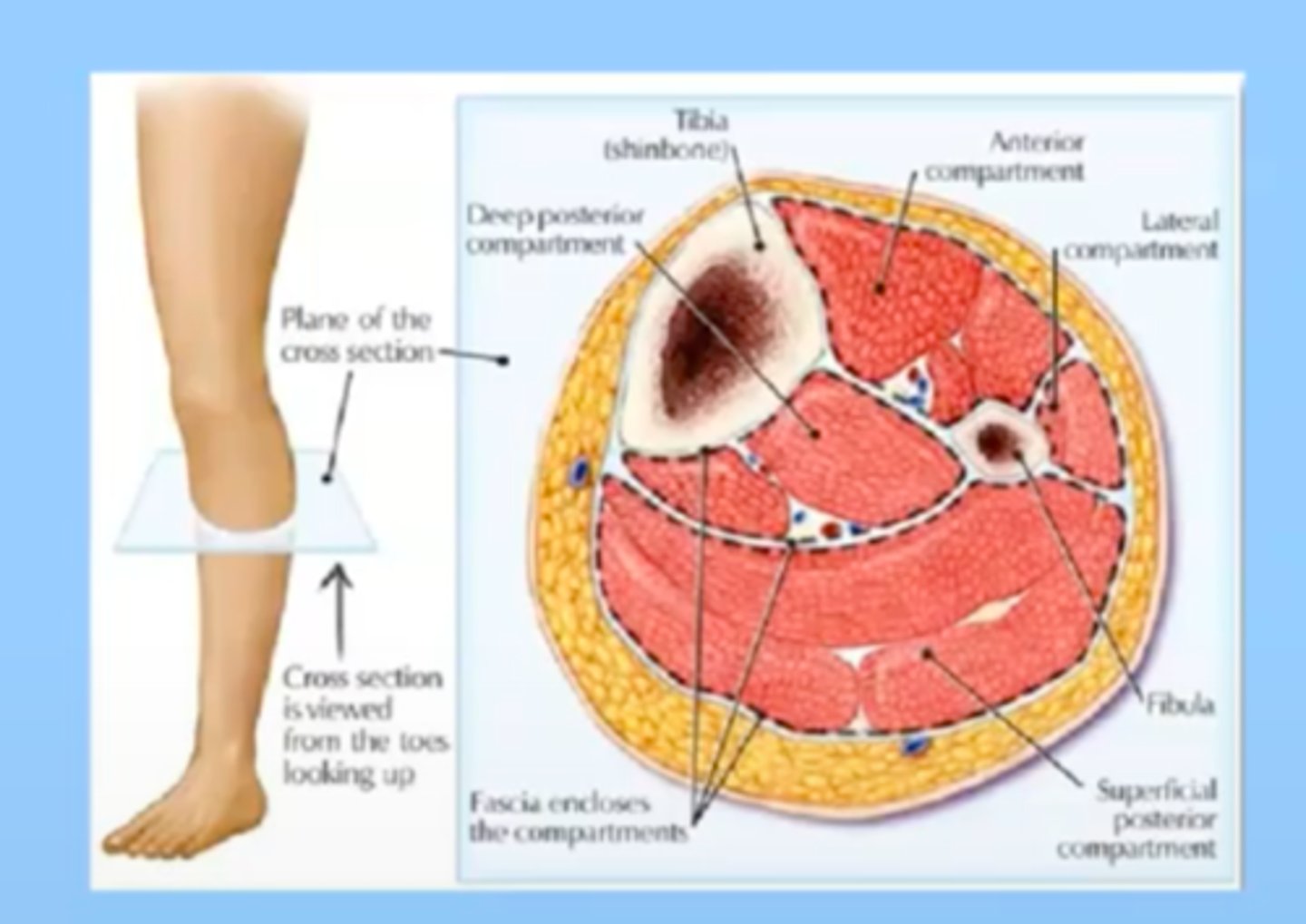 <p>increased pressure within sections of the extremities or abdomen, drastically reducing circulation to that area, causes edema which increases ischemia, tissue is at risk of necrosis. Anything that causes swelling can cause this.</p><p>Body parts are segmented into areas; muscle and blood supply are contained within fascia, so if there is a trauma/break and you have swelling into the tissue within these compartment, its a closed area and can cause necrosis</p><p>see: pain, paresthesia, pallor, pulses weaken, tightly swollen extremity; may/may not develop paralysis if nerve damage</p>