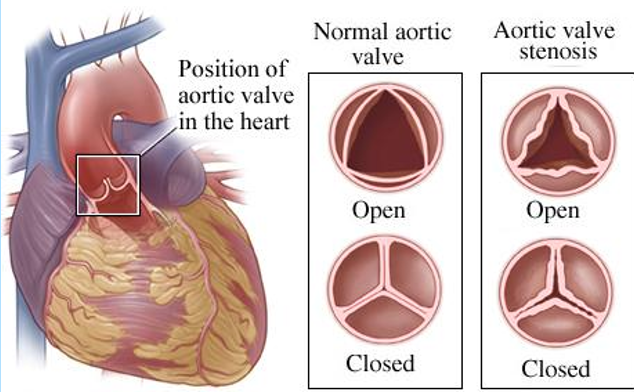 <p><strong><u>Obstructive</u> Disorder</strong></p><ul><li><p class="">Narrowing; Restricted blood flow from the <em><u>left ventricle</u></em> to the <em><u>aorta</u></em>.</p></li><li><p class=""><strong>Typically Asymptomatic</strong>:</p><ul><li><p class="">Failure to Thrive (FTT)</p></li><li><p class="">Faint pulses</p></li><li><p class="">Easy fatigue</p></li><li><p class="">Chest pain</p></li></ul></li></ul><p></p>
