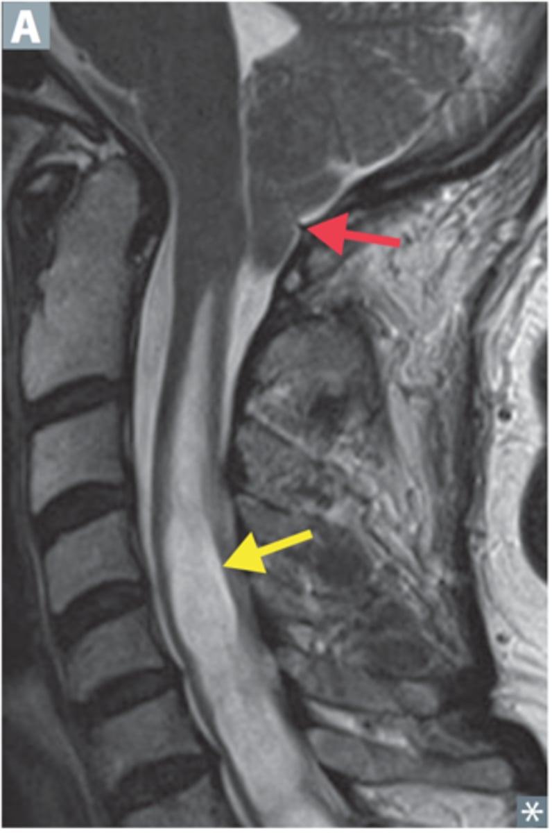 <p>Define Syringomyelia</p>