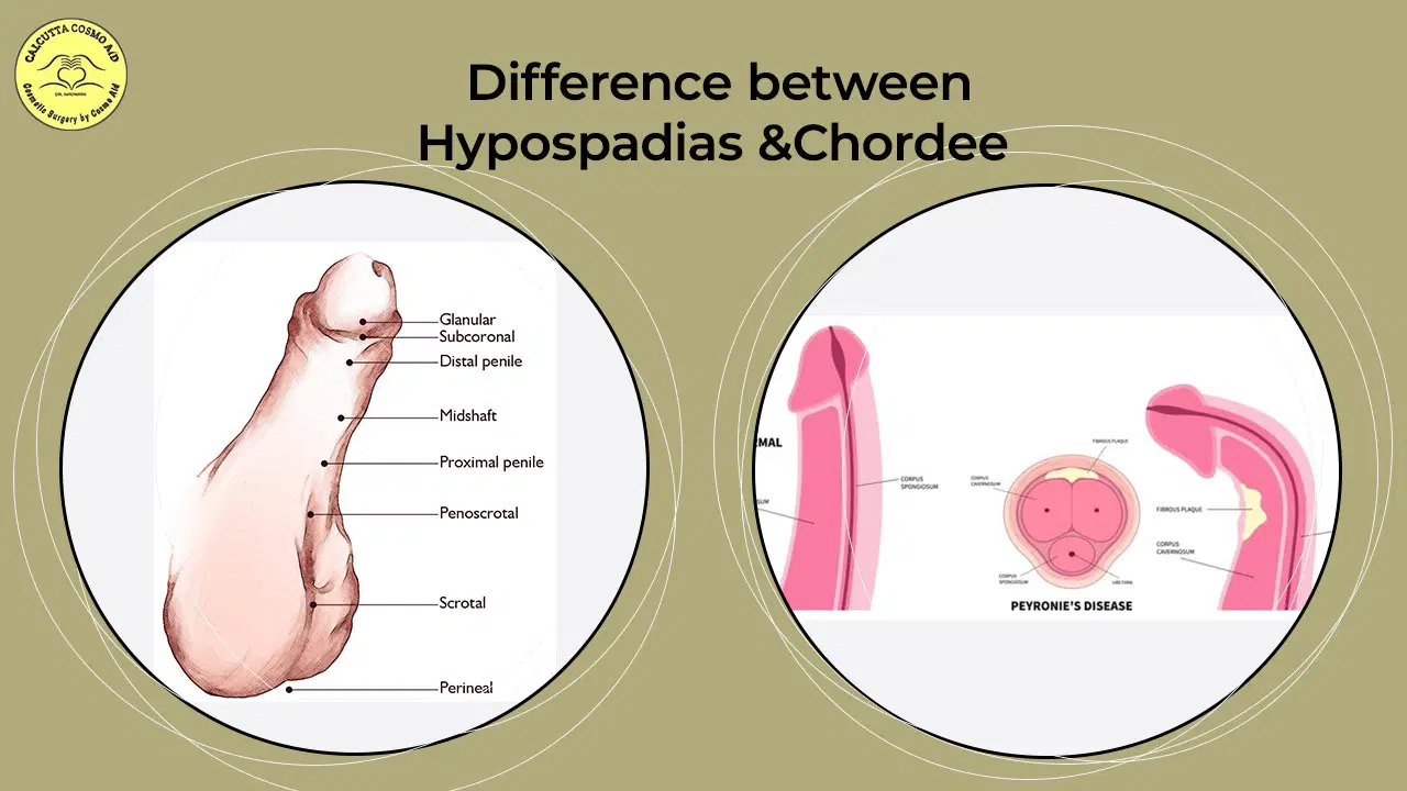 <p>Hypospadias Etiology and pathogenesis:</p>