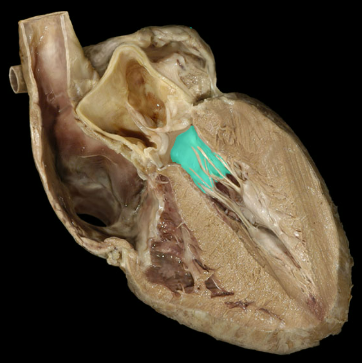 <p>Bicuspid (mitral) valve</p>