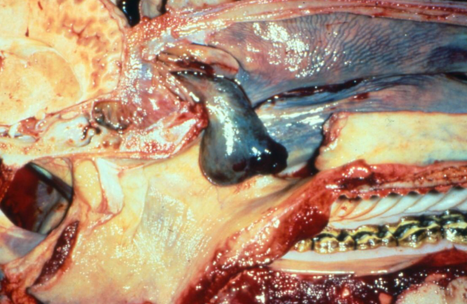 <p>A pedunculated blood-filled mass on the ethmoid</p>