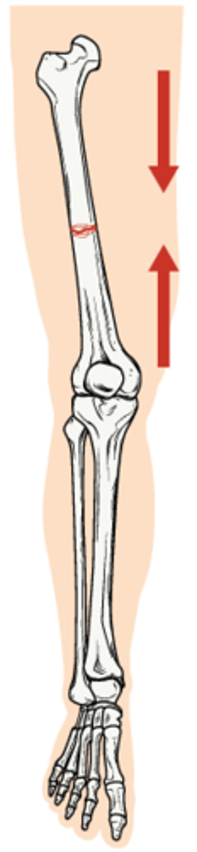 <p>Complete fracture that is straight across the bone at right angles to the long axis of the bone</p>