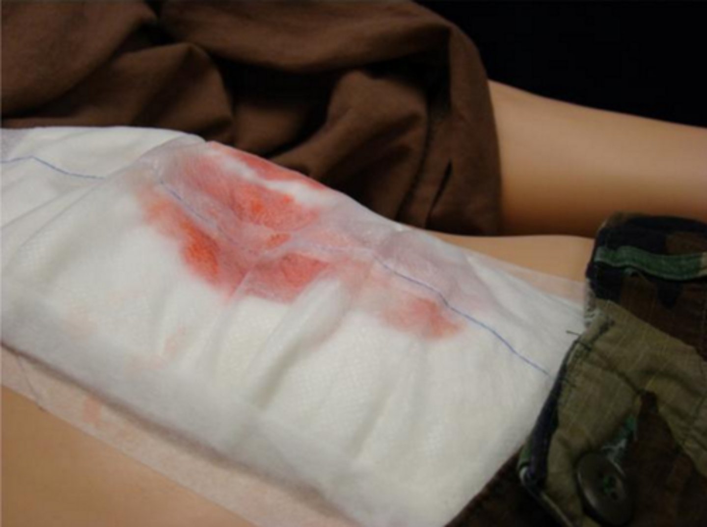 <p>Clear tinge of red/brown - thin and watery, normal and indicates the wound is healing</p>