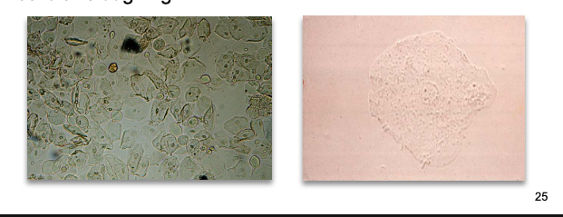 <ul><li><p class=""><strong>Largest cells</strong> in urinary sediment</p></li><li><p class=""><strong>Prominent nucleus</strong> ≈ size of an RBC</p></li><li><p class="">Easily seen at <strong>10X</strong>; may appear <strong>folded/clumped</strong></p></li><li><p class="">Originate from <strong>vagina, female urethra, lower male urethra</strong></p></li><li><p class=""><strong>No pathological significance</strong> — normal sloughing</p></li></ul><p></p>