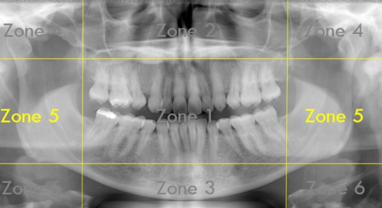 <p>Zone 5: Spine and Ramus</p>