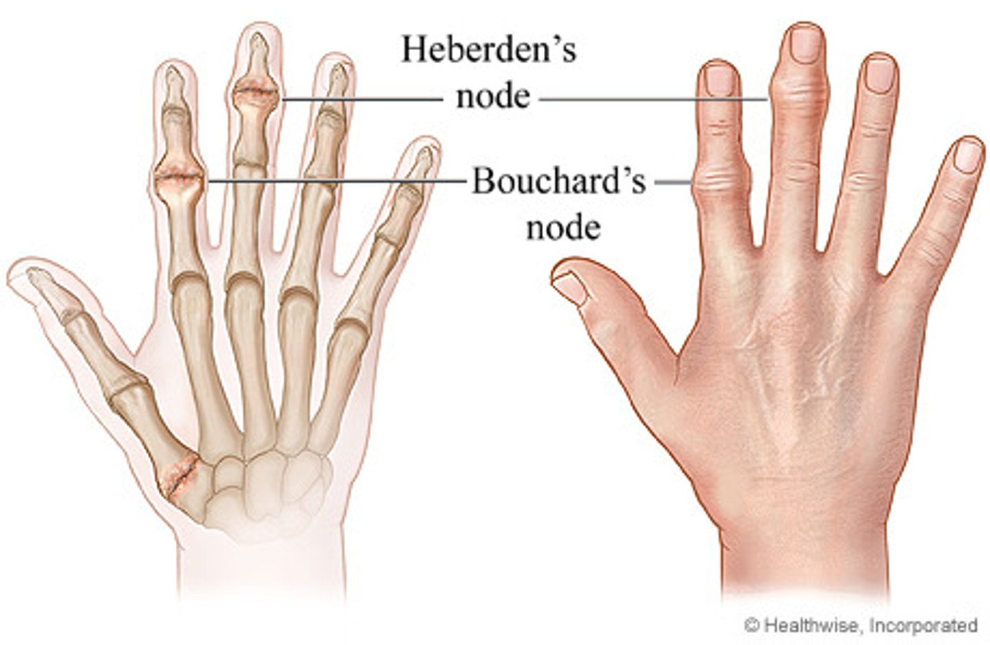 <p>Heberden: DIP</p><p>Bouchard: PIP (less common)</p>