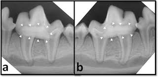 A tooth within a tooth, caused by enamel folding inwards during development.