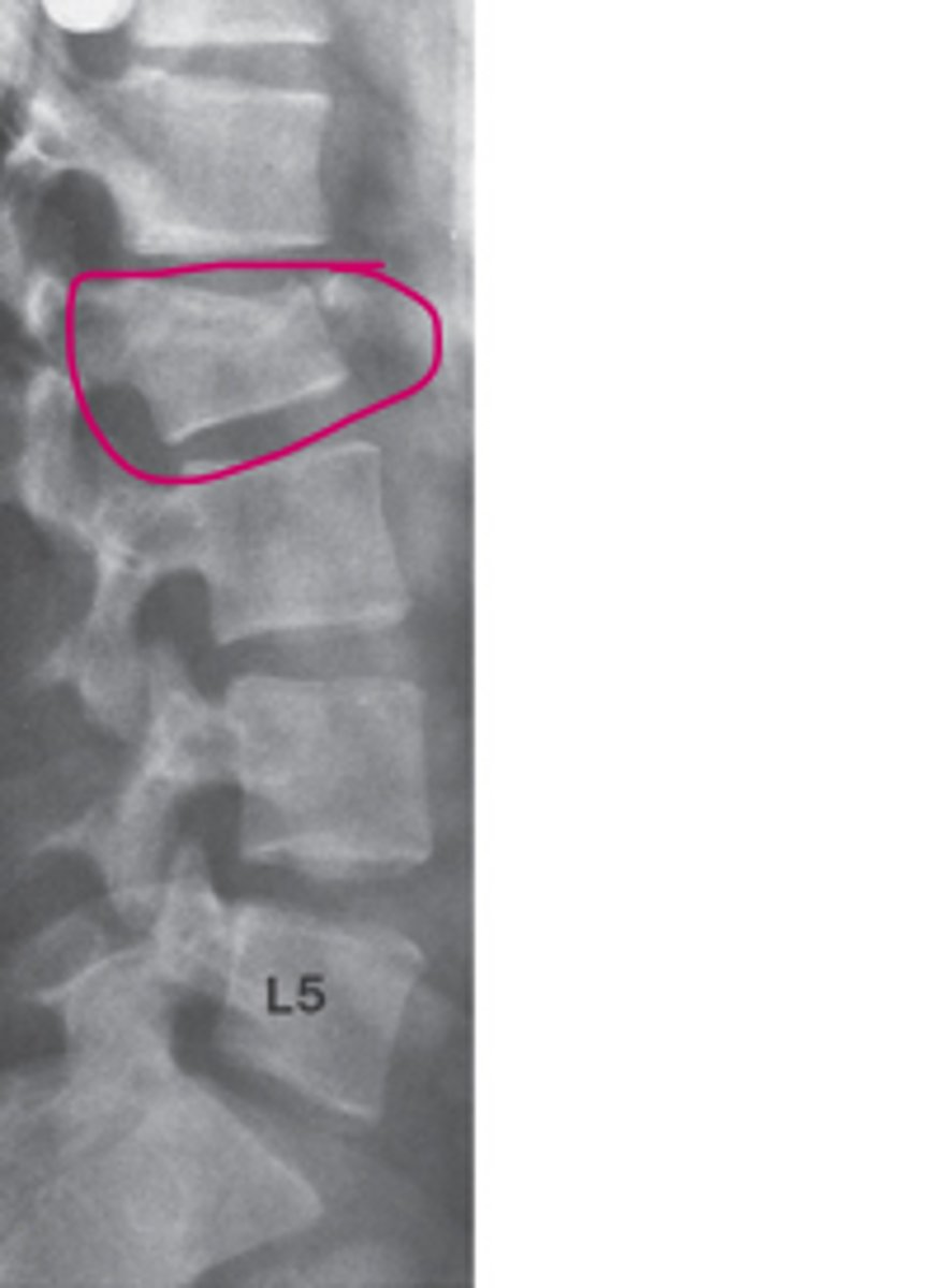<p>What is the most likely diagnosis?</p><p>Spinal tumor, aggravated by trauma</p><p>Abnormality of bone density</p><p>Disruption of facet joints at multiple levels</p><p>Subluxation of L4 over L5</p><p>L2 compression fracture with kyphotic angulation</p>