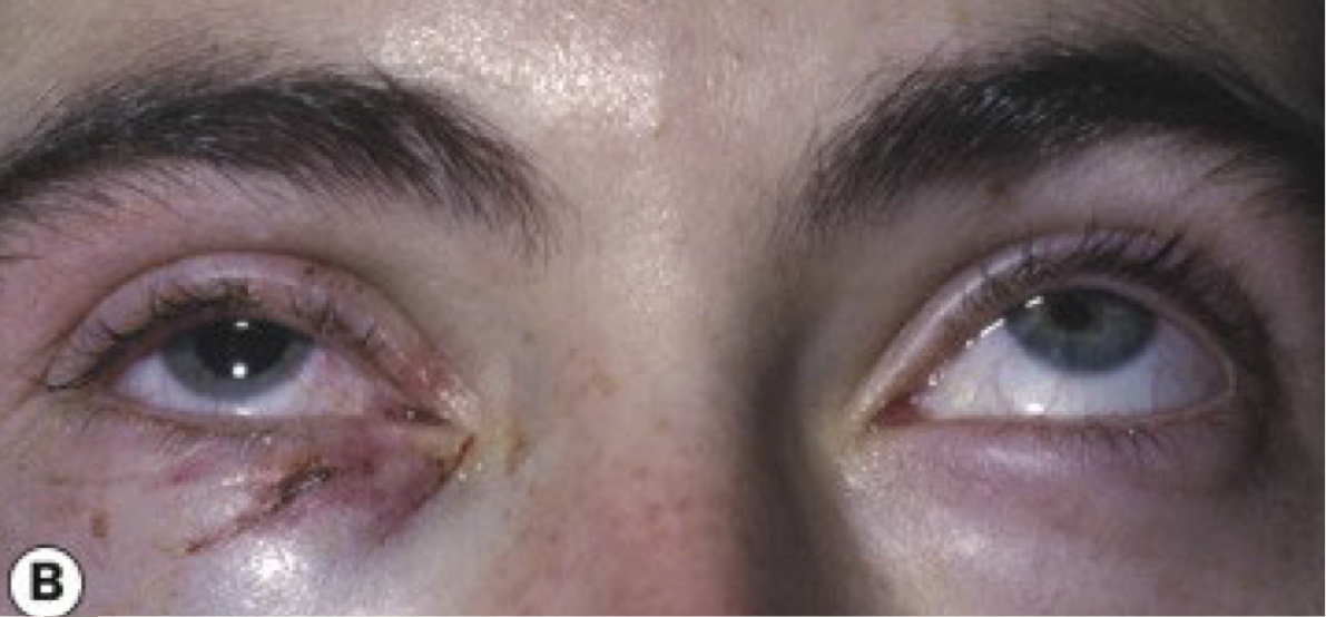 <ul><li><p><span>Orbital floor fractures make up 48% of all orbital fractures (near infraorbital canal) - energy displaces inferior from impact of greater sized object</span></p></li><li><p><strong><span>Symptoms</span></strong><span>: pain with eye movements, diplopia</span></p></li><li><p><strong><span>Presentation</span></strong><span>:</span></p><ul><li><p><span>Lid ecchymosis (bruising) and edema</span></p></li><li><p><span>Subcutaneous emphysema/crepitus: crackling sensation on palpation due to air in the subcutaneous tissue</span></p></li><li><p><span>Infraorbital nerve anesthesia: will involve the lower lid, cheek, side of the nose, upper lid, upper teeth and gum</span></p></li><li><p><span>Limited extraocular muscle motility: inferior rectus and inferior oblique will be involved</span></p><ul><li><p><span>Can be the result of a hemorrhage or edema</span></p></li><li><p><span>Can be due to entrapment</span></p></li><li><p><span>Can be due to entrapment</span></p></li></ul></li><li><p><span>Bone step off: present when the orbital rim is involved;&nbsp;A portion of the rim near the fracture will appear lower</span></p></li><li><p><span>Enophthalmos: posterior displacement of the globe (if severe)</span></p></li><li><p><span>proptosis</span></p></li><li><p><span>Other ocular findings: traumatic iritis, corneal abrasion, hyphema, increased&nbsp;intraocular pressure, lens subluxation or dislocation, retinal pathology</span></p></li></ul></li><li><p><strong><span>Work up</span></strong><span>: CT scan</span></p></li><li><p><strong><span>Treatment</span></strong></p><ul><li><p><span>Nasal decongestants: individuals are advised to avoid blowing their nose for 14 days post injury</span></p></li><li><p><span><span>Systemic antibiotics</span></span></p></li><li><p><span><span>Systemic corticosteroids for severe edema</span></span></p></li><li><p><span><span>Surgical repair: done 2 weeks after initial trauma</span></span></p></li></ul></li></ul><p></p>