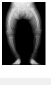 <p>is osteomalacia but in children </p><p><span>•</span><span style="font-family: Arial">Bones of children are inadequately mineralized causing softened, weakened bones</span></p><p><span>•</span><span style="font-family: Arial">Bowed legs and deformities of the pelvis, skull, and rib cage are common</span></p><p><span>•</span><span style="font-family: Arial">Caused by insufficient calcium in the diet, or by vitamin D deficiency</span></p>