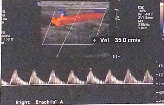 <p>According to published studies, is this PSV in the following image within normal limits?</p>