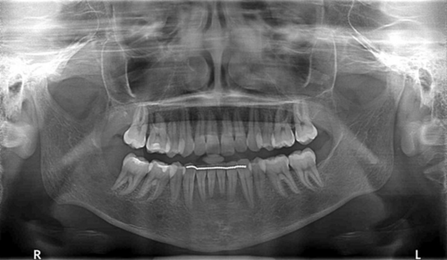 <p>After checking a serum levels you see</p><p>Elevated PTH</p><p>Normal Vitamin D</p><p>Elevated calcium</p><p>What is the diagnosis?</p>