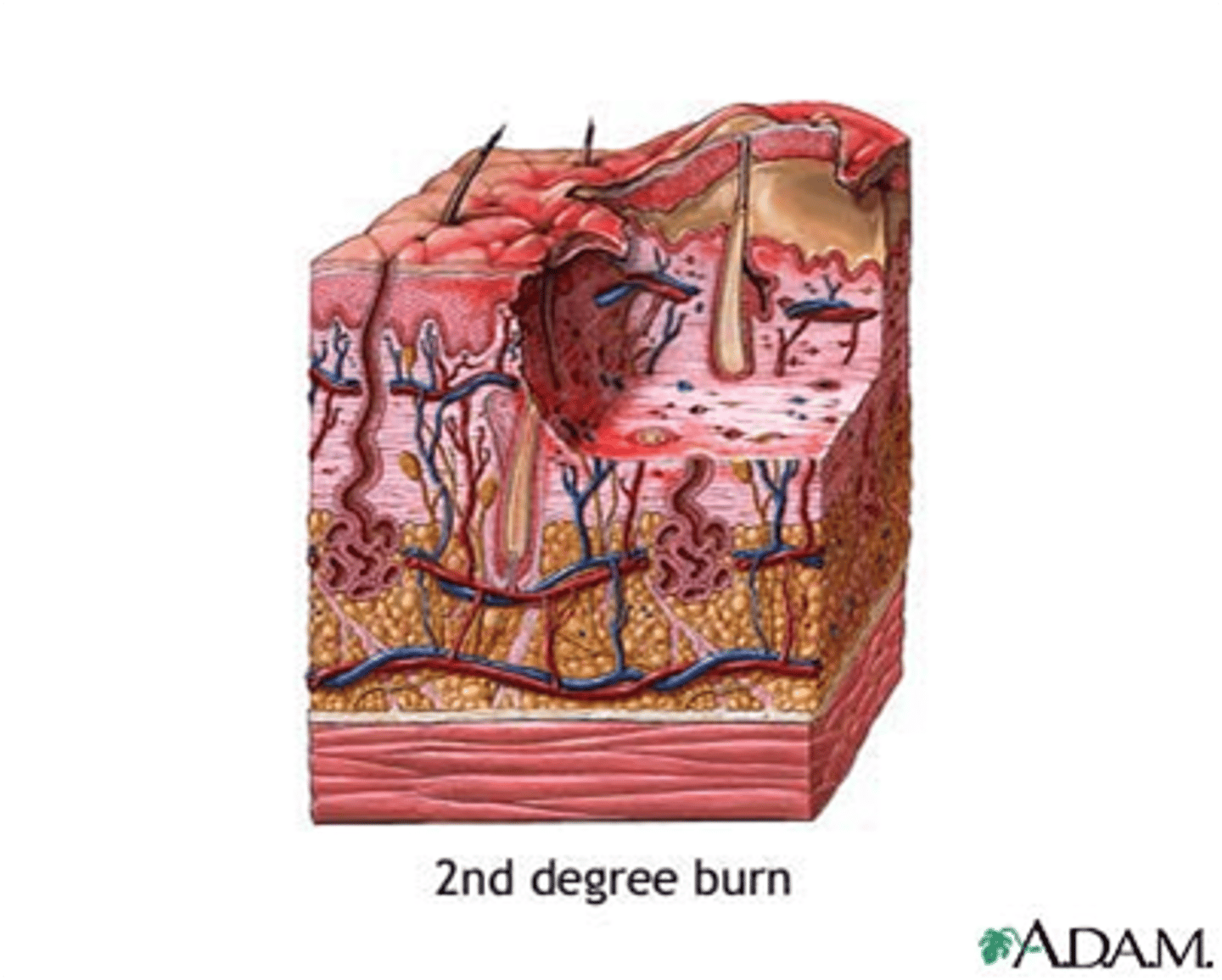 <p>A partial-thickness burn involving the epidermis and the dermis.</p>